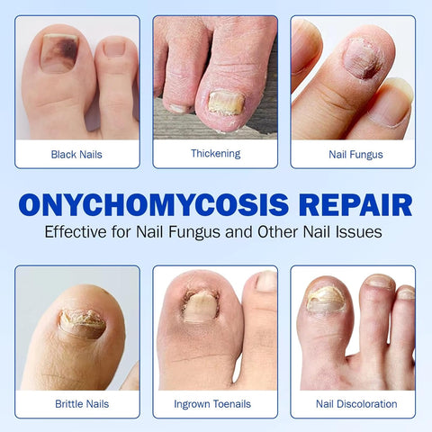 Nighttime Renewal Fungal Nail Patches