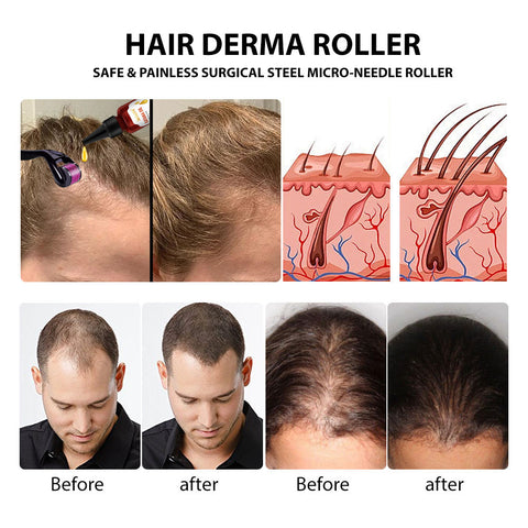 Hair Growth Derma Roller